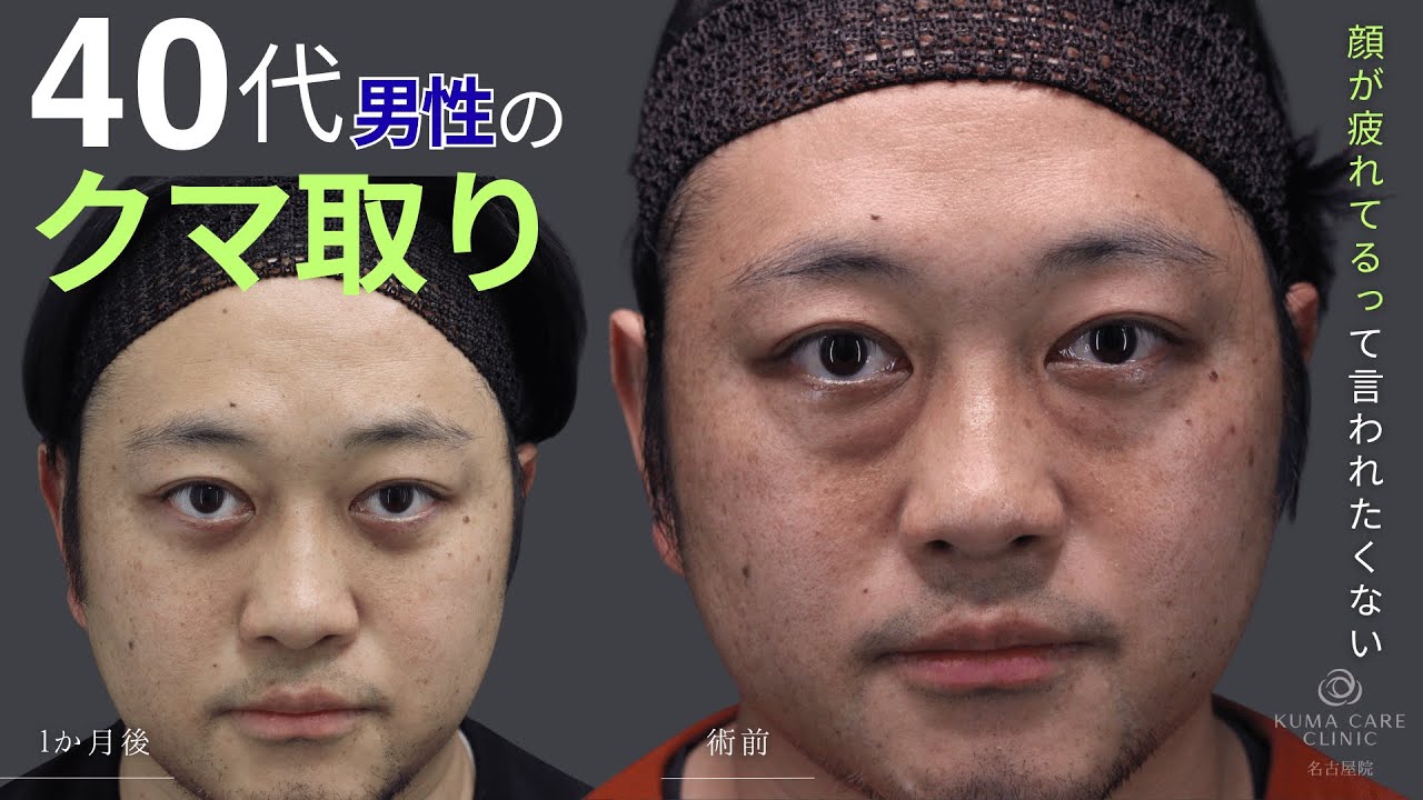 【クマ取り脱脂術】疲れ顔を何とかしたい！40代前半 男性