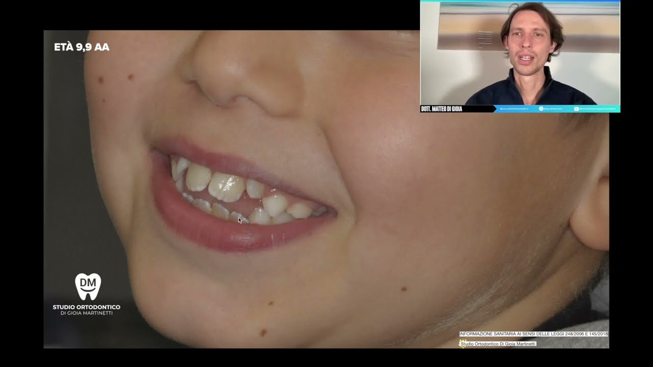 ALLINEARE I DENTI E CHIUDERE IL MORSO CON GLI ALLINEATORI TRASPARENTI NEL BAMBINO DEGLUTIZIONE ok!