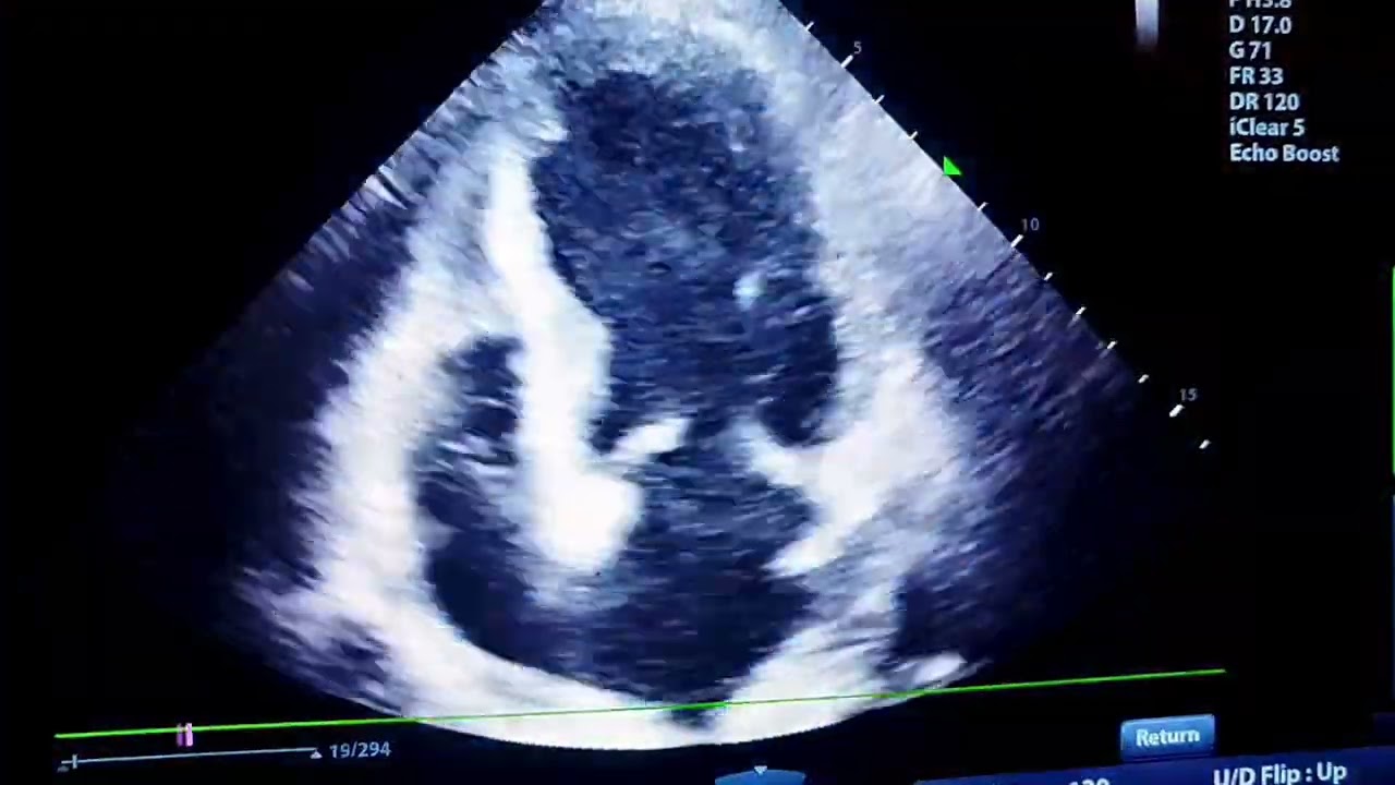 Extensive Anterior STEMI