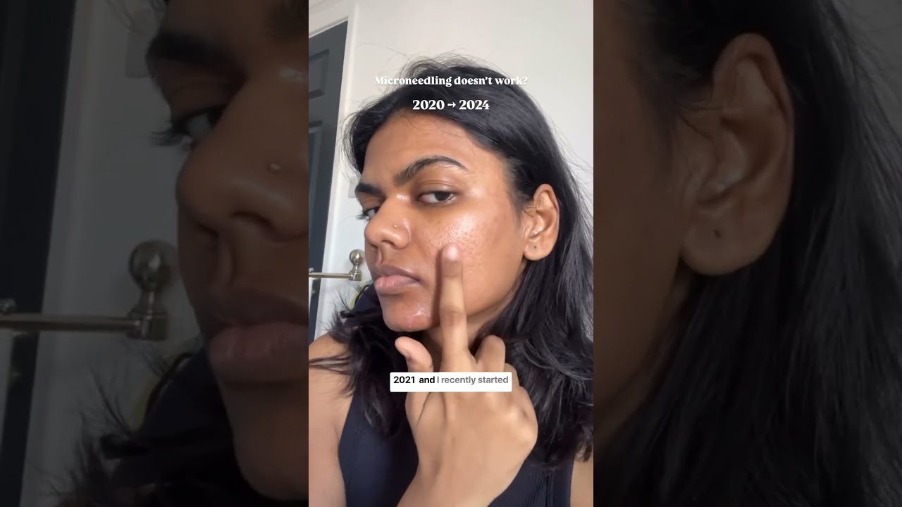 Building "new skin"  with microneedling takes time and patience 