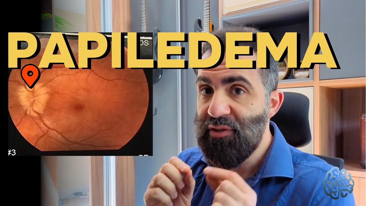 PAPILEDEMA - O Inchaço do Nervo Óptico que pode te CEGAR!