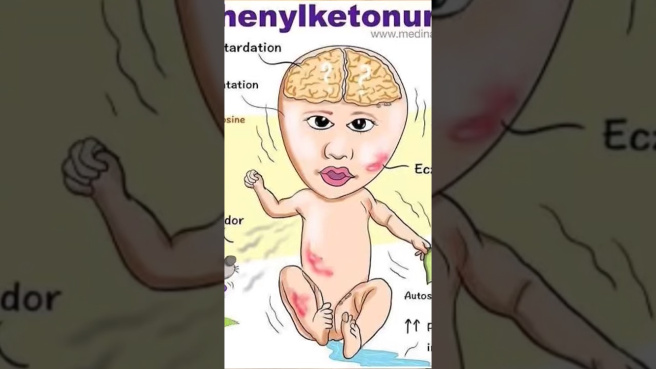 PHENYLKETONURIA PKU Disability Comes Under PwD Quota Benefits Neet Jee Govt 2026 SVP फेनिलकेटोनुरिया
