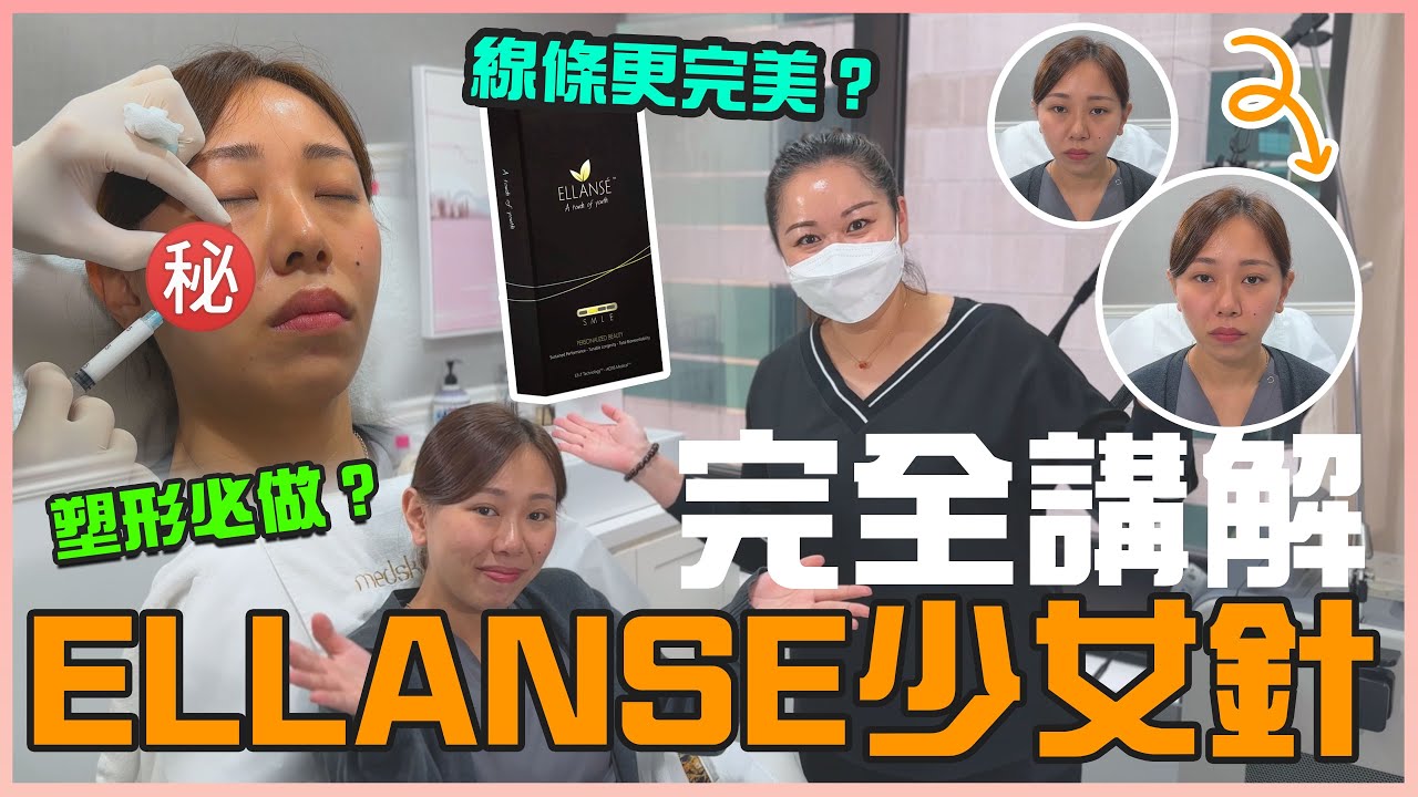 ELLANSE少女針｜ 想做輪廓塑形一定要揀佢？打完後立即消除虎紋，立即提升蘋果肌？痛唔痛？點打？ 真人拍片過程全拆解！  #medskinHK