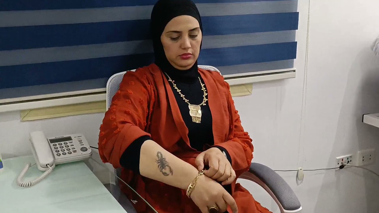 تالت جلسه في ازاله التاتو باليزر كانت عذاب😭