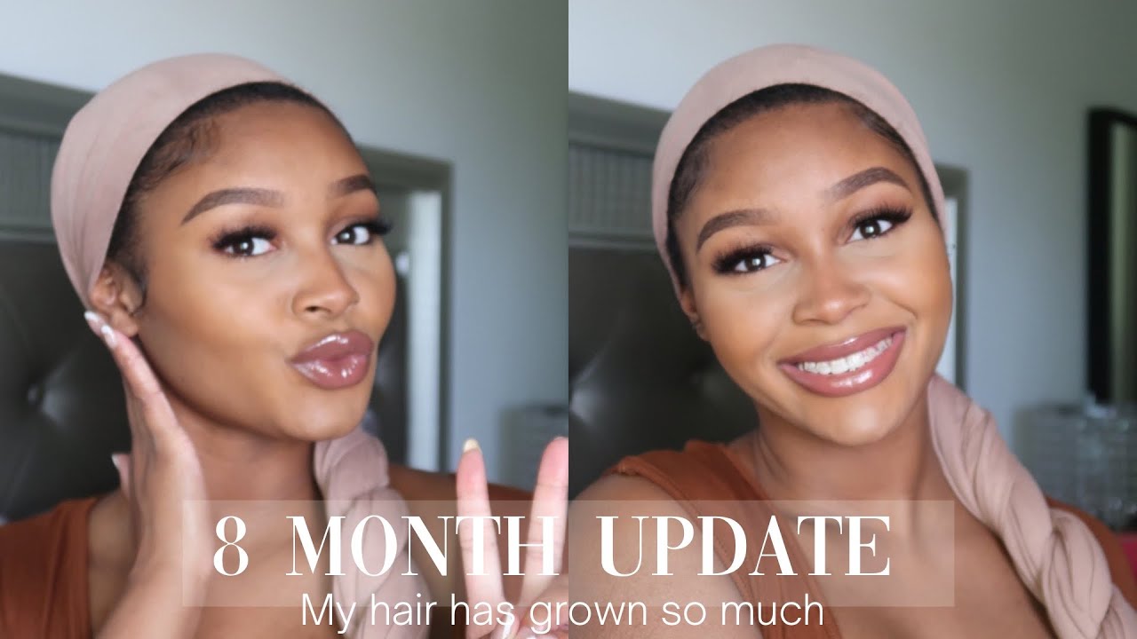 Hair Transplant Month 8 | Longevita