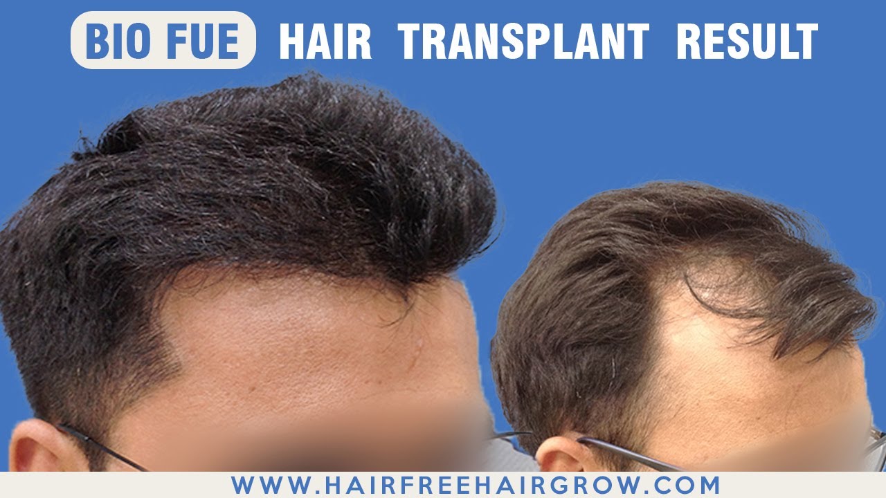 😱Best Hair Transplant Result in 5 Months | By- Dr. Richa Sanmukhani, Ahmedabad Clinic | BIO-FUE