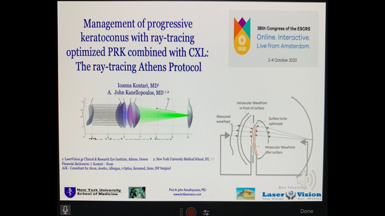 RayTracing Customization in AthensProtocol CXL for keratoconus: Kanellopoulos, MD