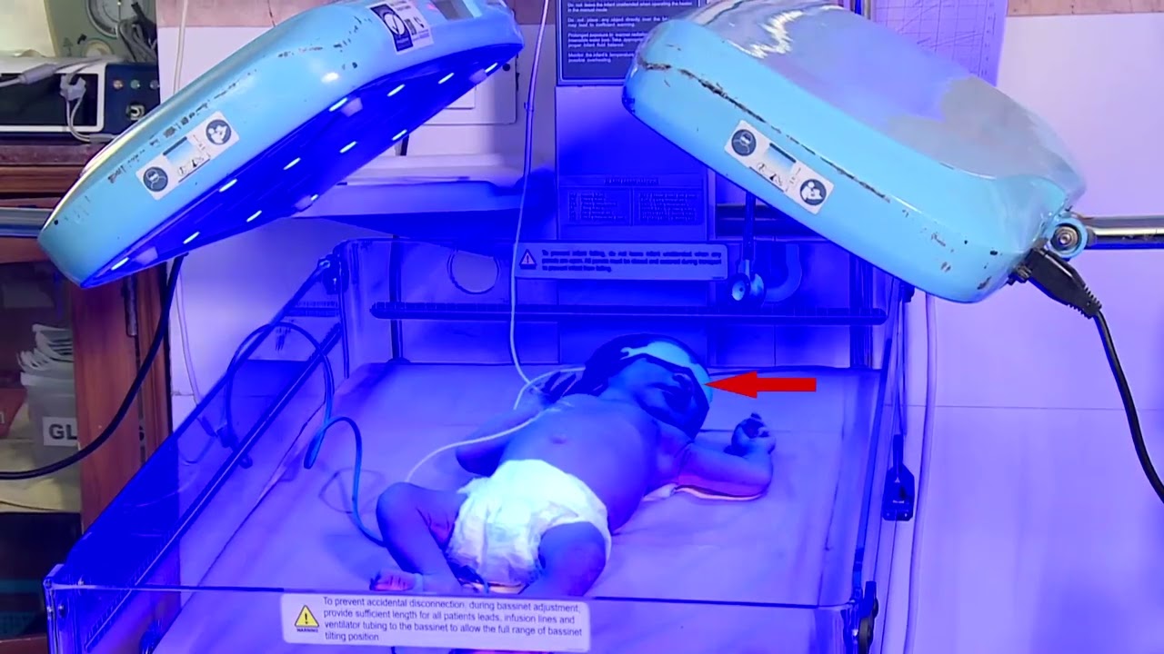 Care of an infant  while under phototherapy 2021