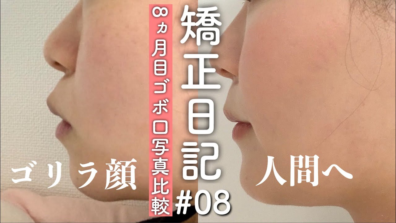 【矯正日記#08】8ヵ月経過報告🌈ゴボ口、人中の比較写真と下の歯アンカースクリュー追加の話【ワイヤー矯正】by 桃桃