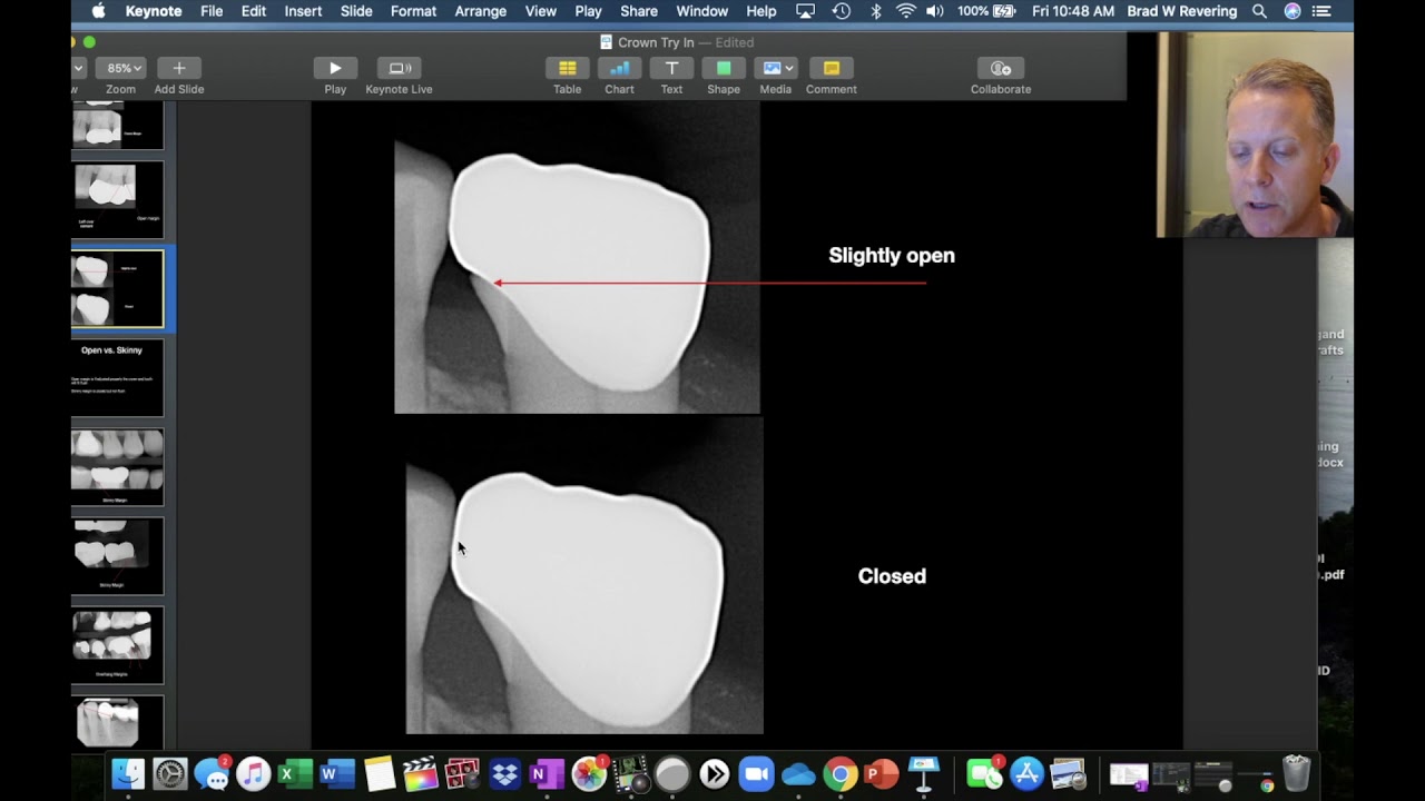 Crown Try In For Dental Staff
