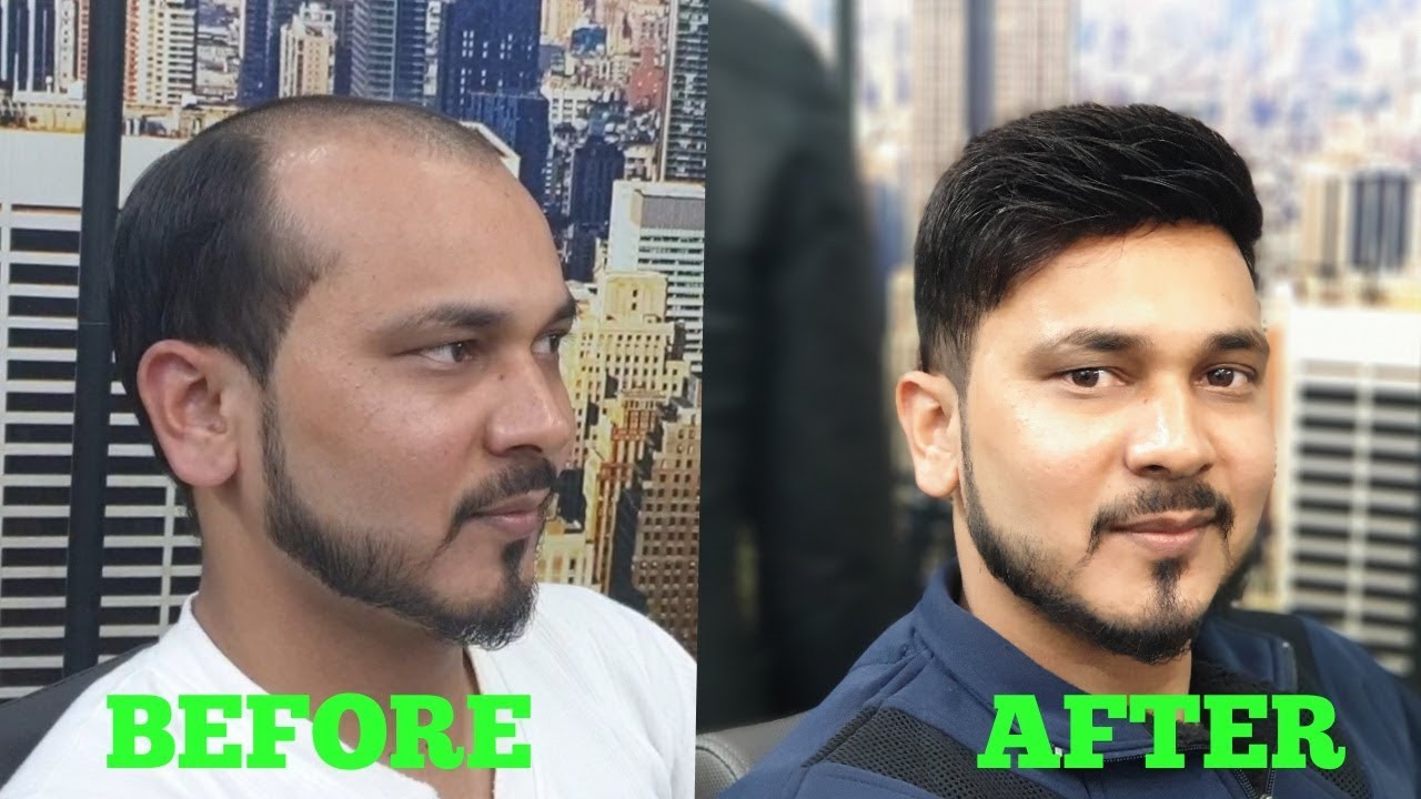 best hair wig replacement system by master RIZY in india AFTER & BEFORE 9582581323,8882017181,