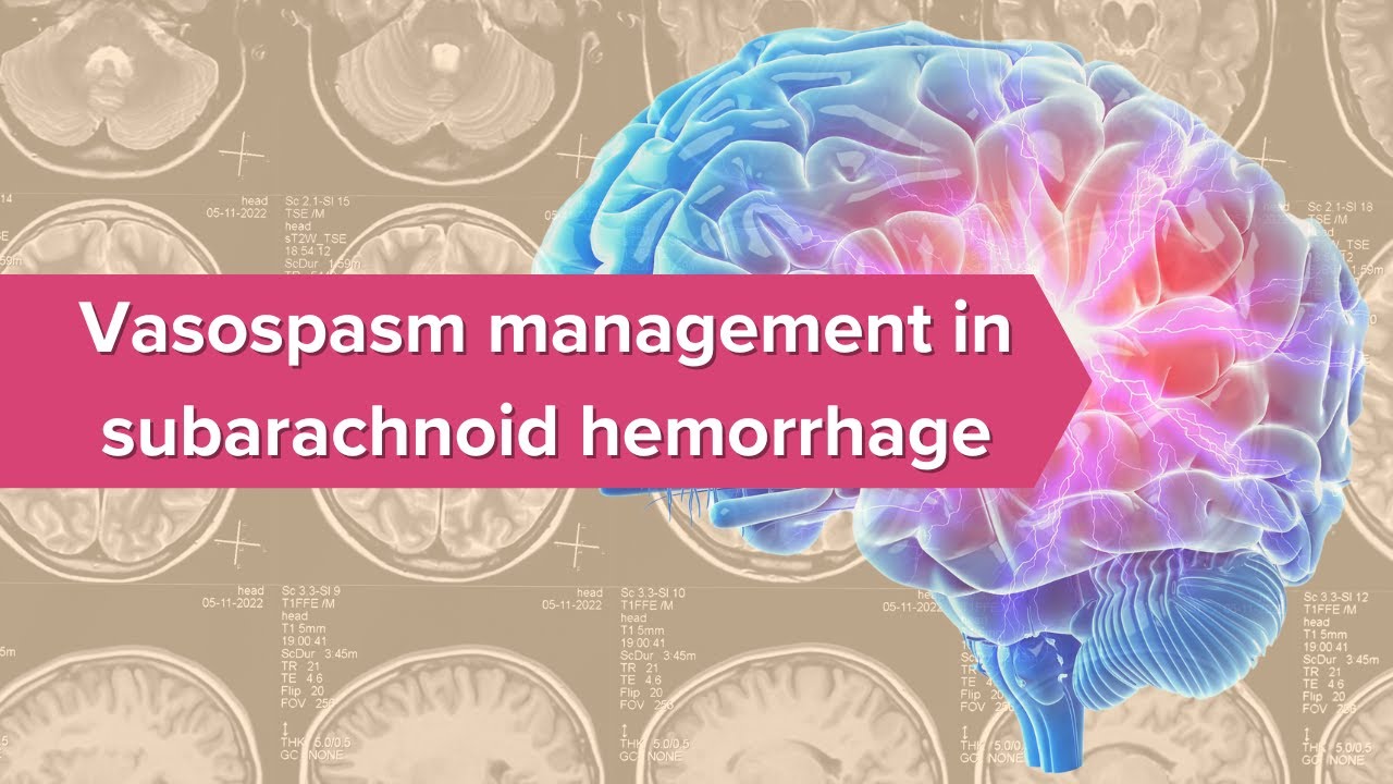 Vasospasm management in subarachnoid hemorrhage for ICU Nurses
