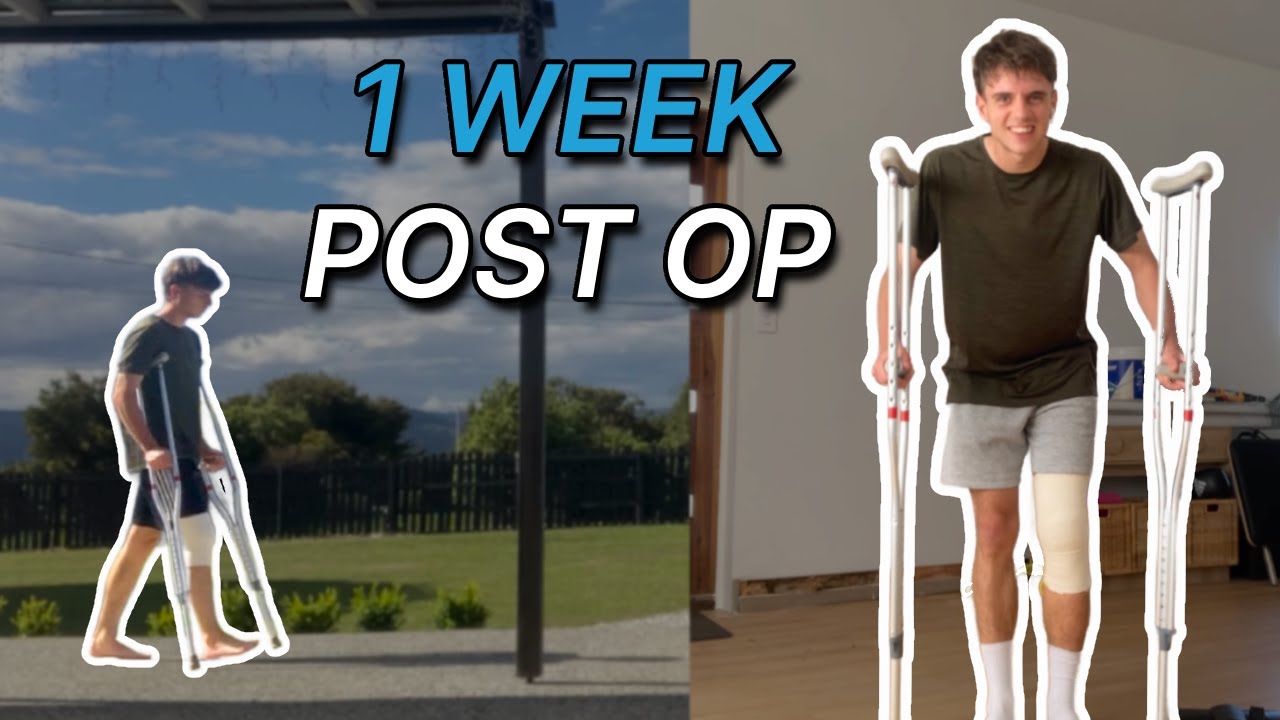 My 1 Week Post-ACL Surgery Experience
