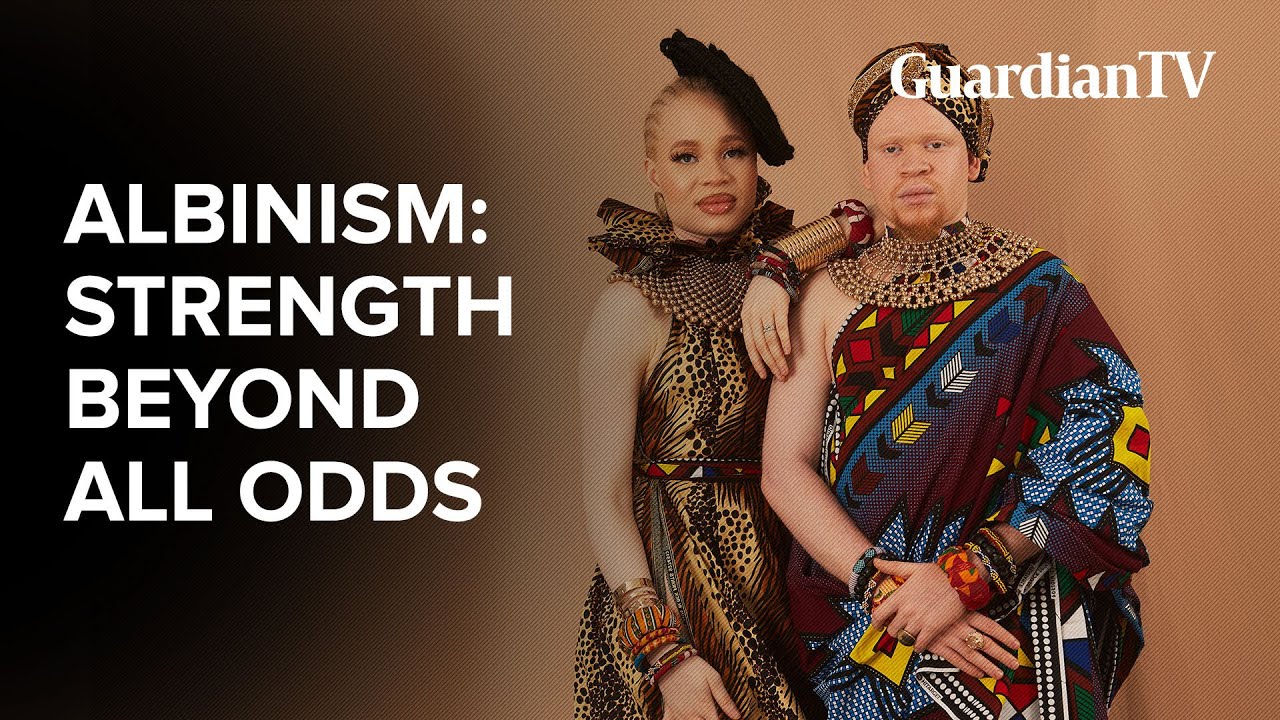 Strength beyond all odds: Living with albinism in Nigeria