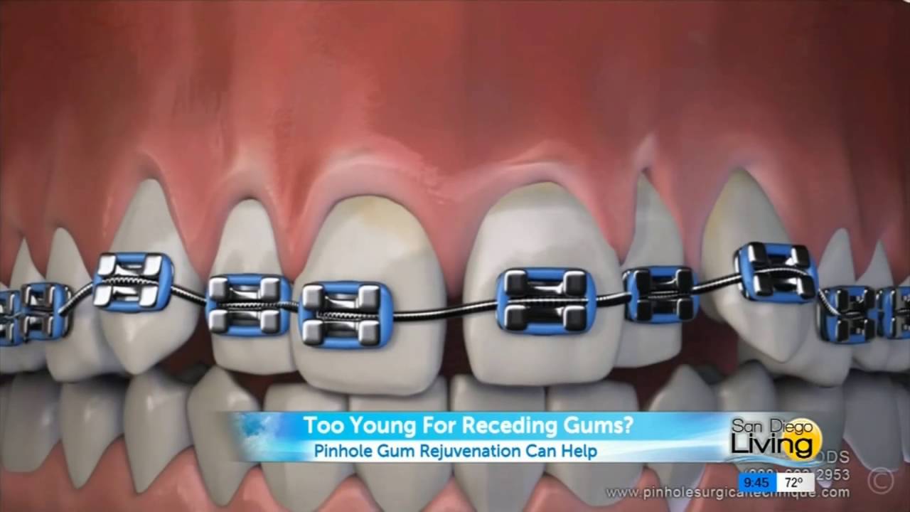 Dr. Tina Beck Describes Chao Pinhole Gum Rejuvenation On San Diego Living
