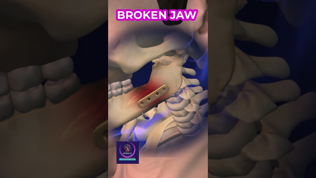 Jaw Fractures Demystified: Causes, Risks, and Treatment Plans