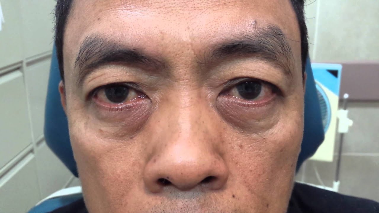 Blepharospasm