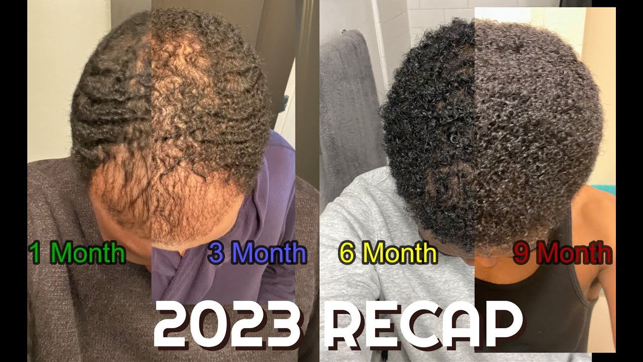 Balding to Afro 9 Month FUE Hair Transplant + 2023 Hair Recap
