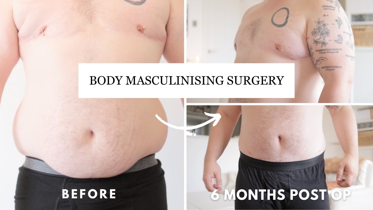 6 Months Post Body Masculinising Surgery!