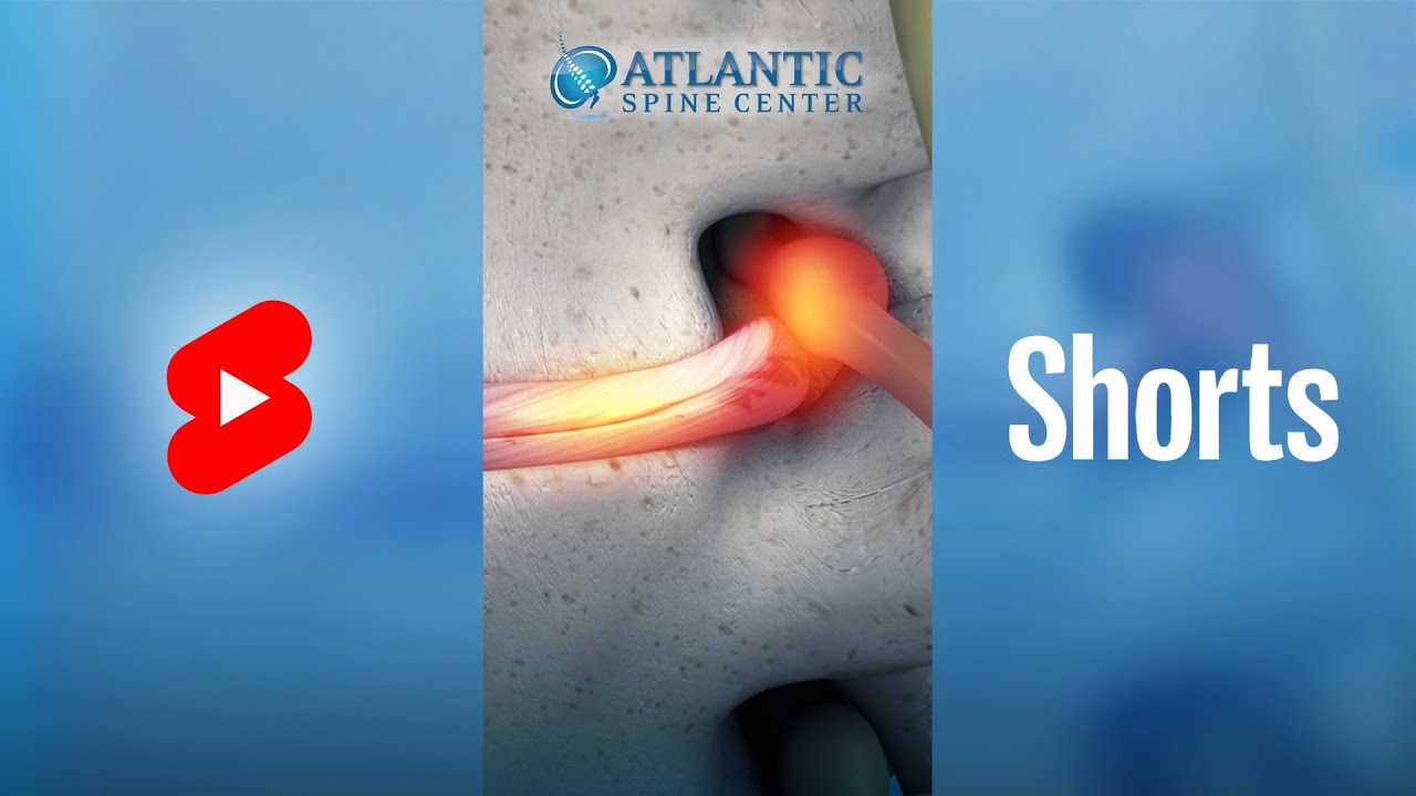 What Is Lumbar Degenerative Disc Disease? | Intervertebral Disc Height Loss #Shorts