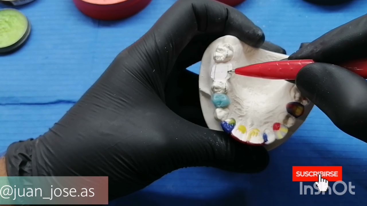 Encerado primer molar superior - wax up first molar
