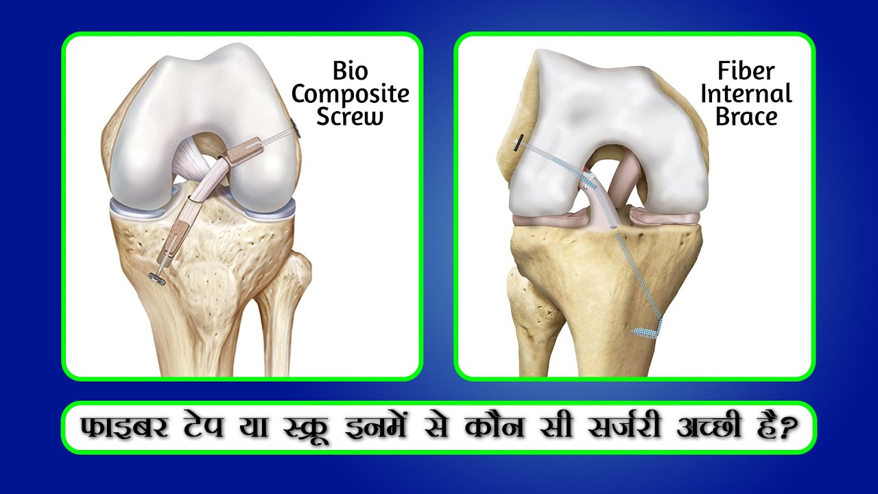 Internal Brace (Fiber tape) फाइबर टेप या स्क्रू(Screw) इनमे से कोनसी सर्जरी अच्छी है ?