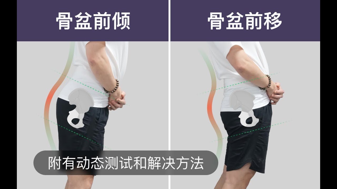 骨盆前倾与骨盆前移的区别以及纠正方法的不同