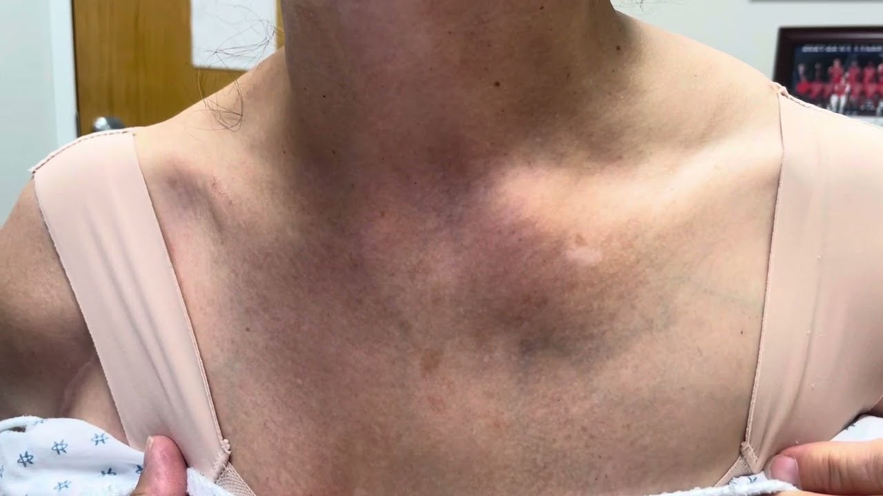 What does Sternoclavicular joint inflammation look like? ￼