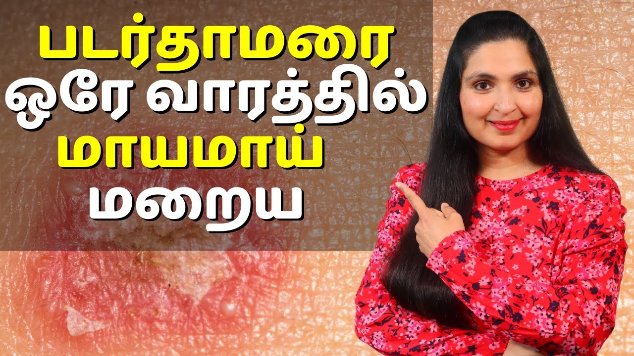 படர்தாமரை மற்றும் தழும்பு ஒரே வாரத்தில் மாயமாய் மறைய / Quickest Way to Get Rid of #RINGWORM