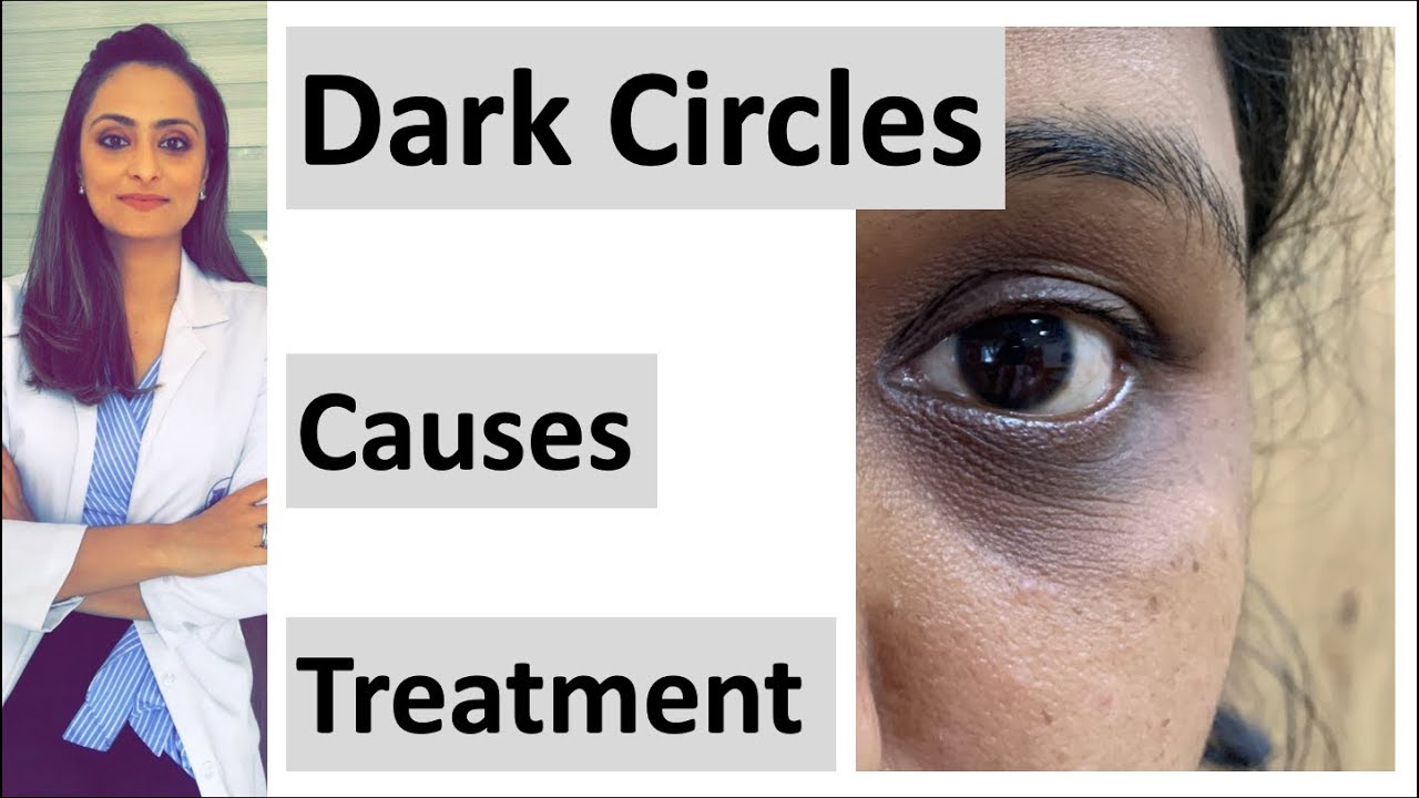 How to get rid of Dark circles | causes & treatment | creams, peels, lasers, fillers, home remedies