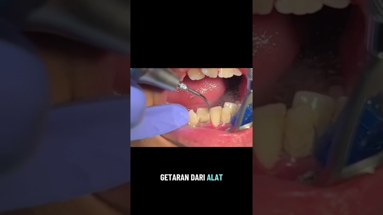 Scaling nyaman, detail dan cepat di Endental Care #scaling  #dentalclinic #bekasi