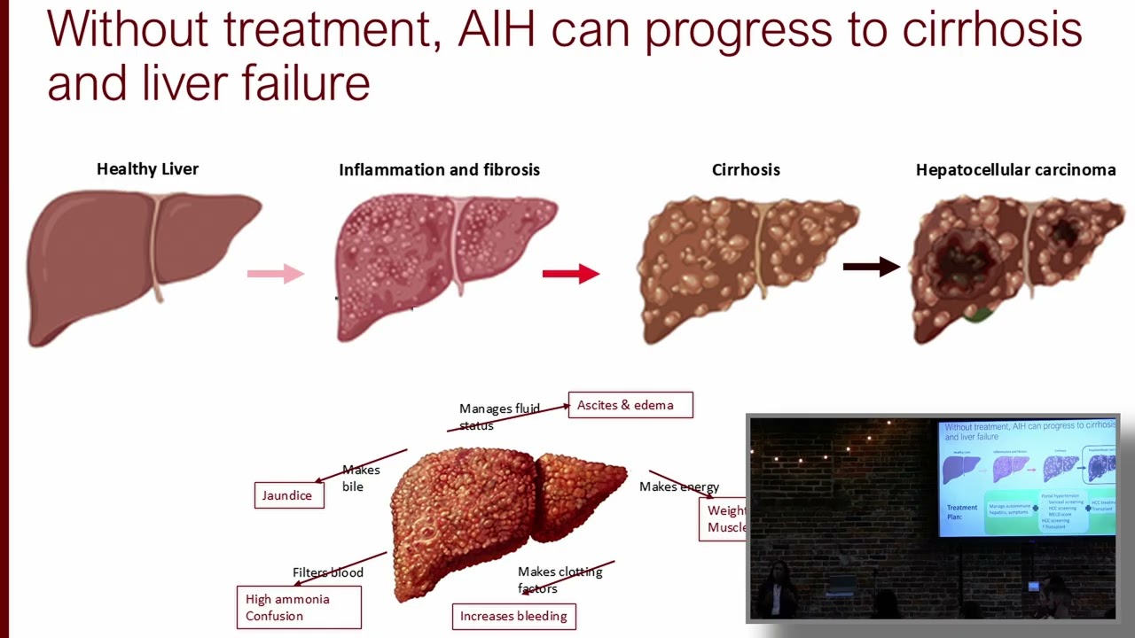 Autoimmune Hepatitis Overview: Symptoms, Diagnosis, Treatment & Monitoring