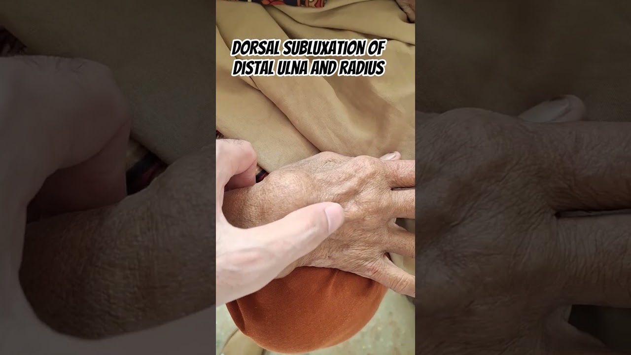 Rheumatoid hands | Dorsal subluxation of distal ulna and radius #clinicalexamination