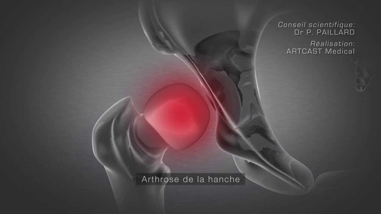 Proth&egrave;se totale de la hanche