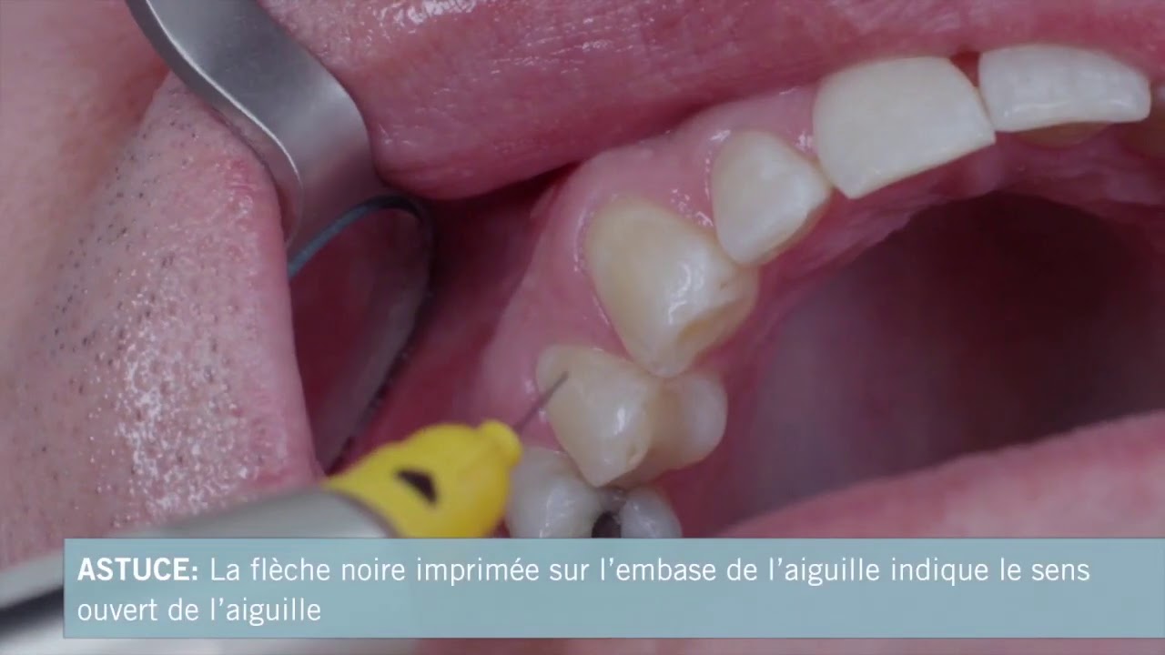 Conseils et astuces pour l’anesthésie intraligamentaire - Avec les seringues SOPIRA Citoject