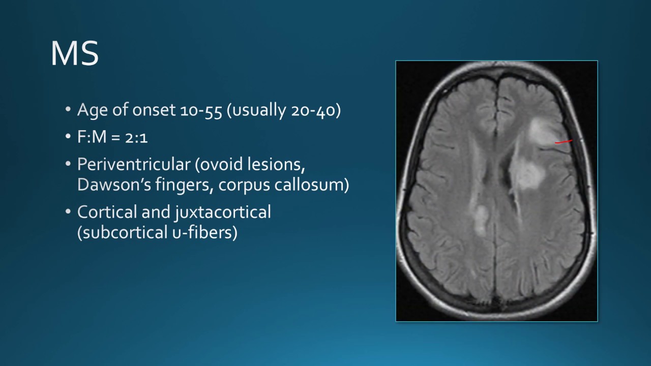 White Matter Disease