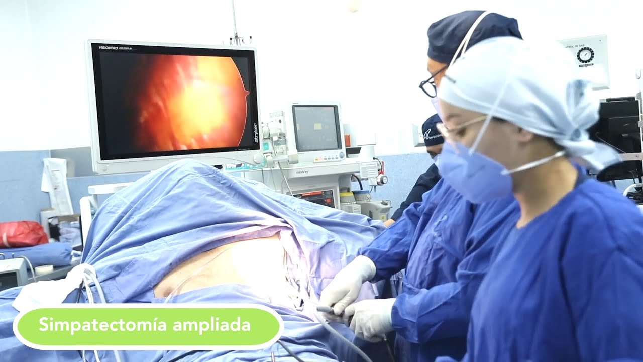 Operacion Sudoración Compensatoria (Más de 2.000 pacientes operados exitosamente)