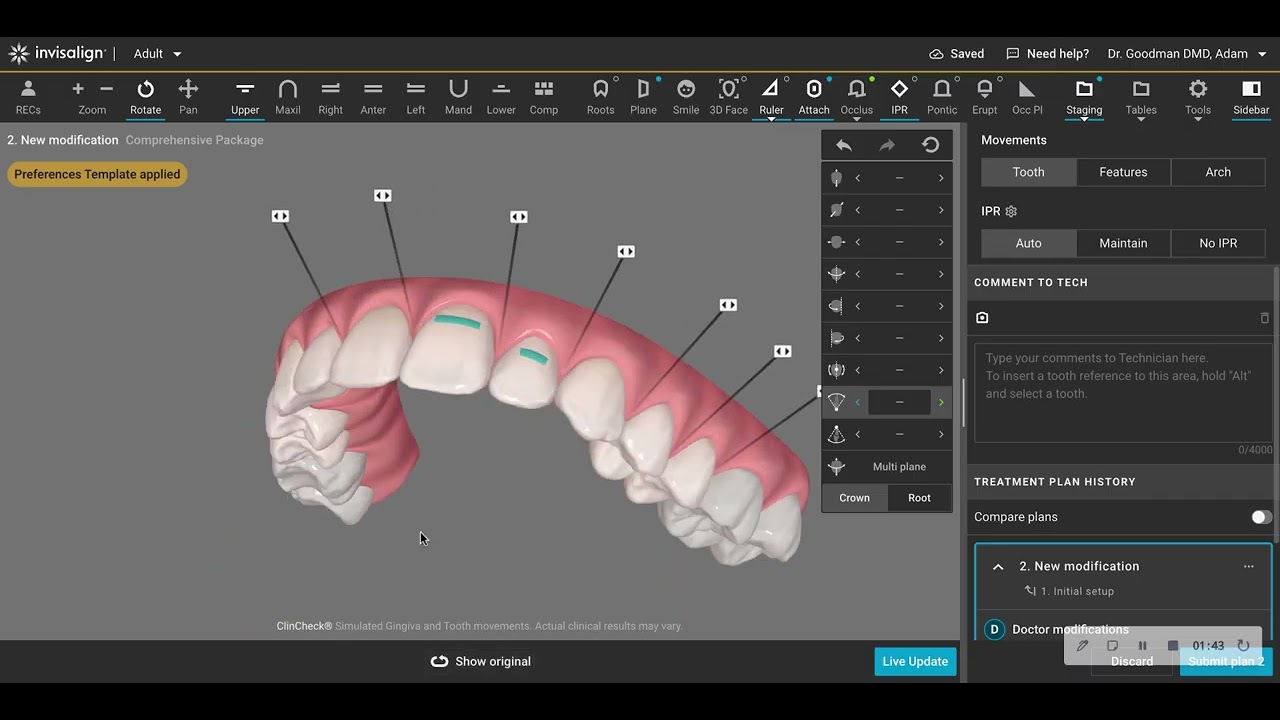 Making an Easy Invisalign Treatment Less Complex with Clincheck Modification