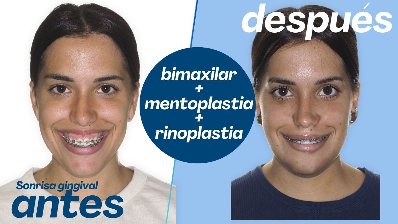 Cirugía bimaxilar Caso 