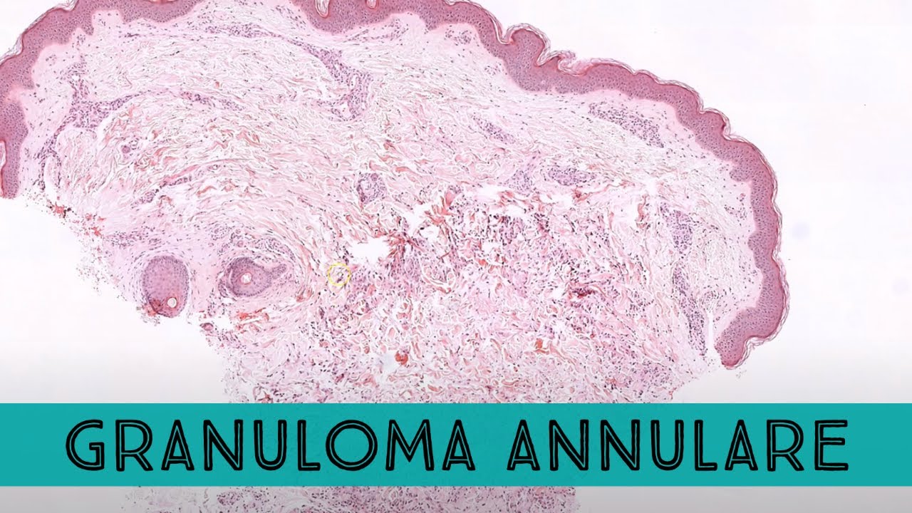 Granuloma annulare under the microscope (mimic of ringworm tinea dermatophytosis) pathology dermpath