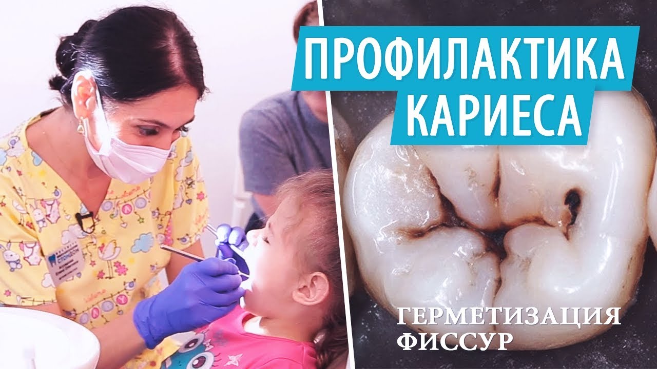 Герметизация фиссур у детей. Профилактика кариеса