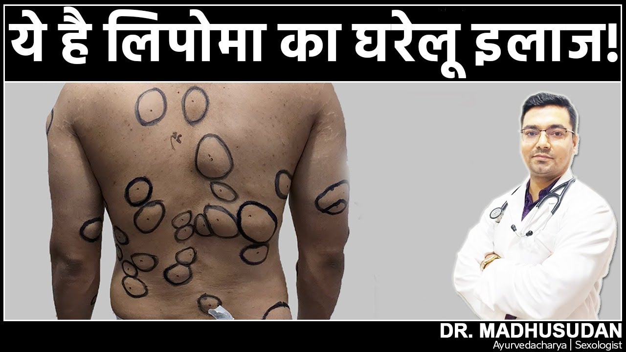 ये है लिपोमा का घरेलू इलाज ! || Lipoma Ka Gharelu Ilaj || Dr. Madhusudan