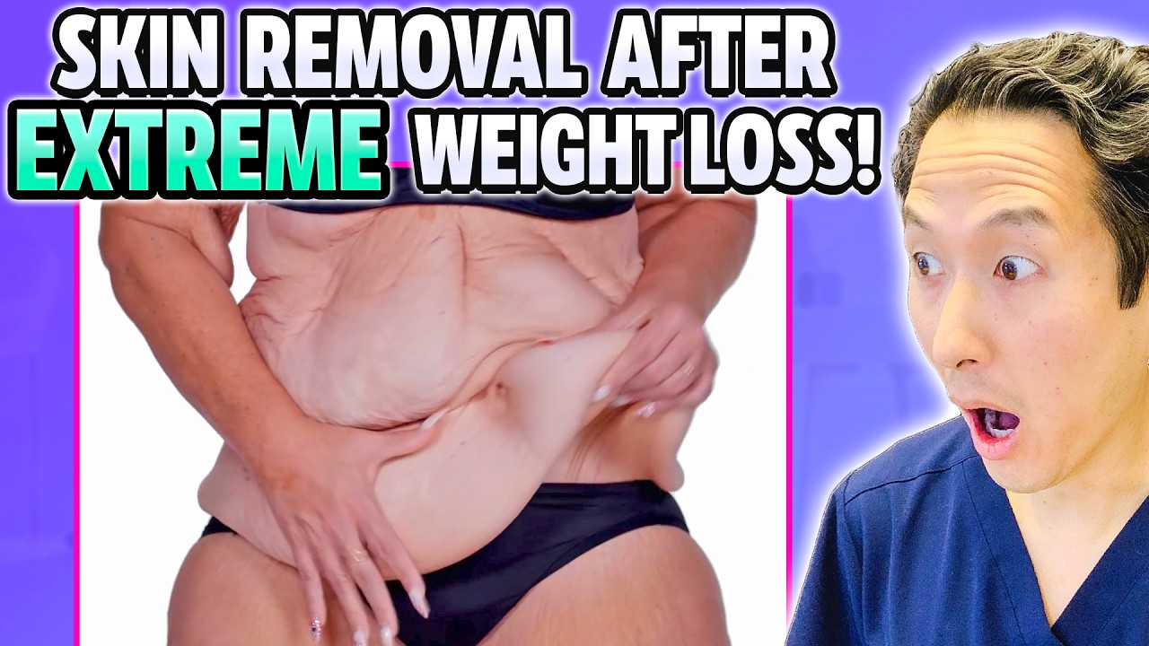 MASSIVE Skin Removal After 300 Lb Weight Loss! Plastic Surgeon Reacts!