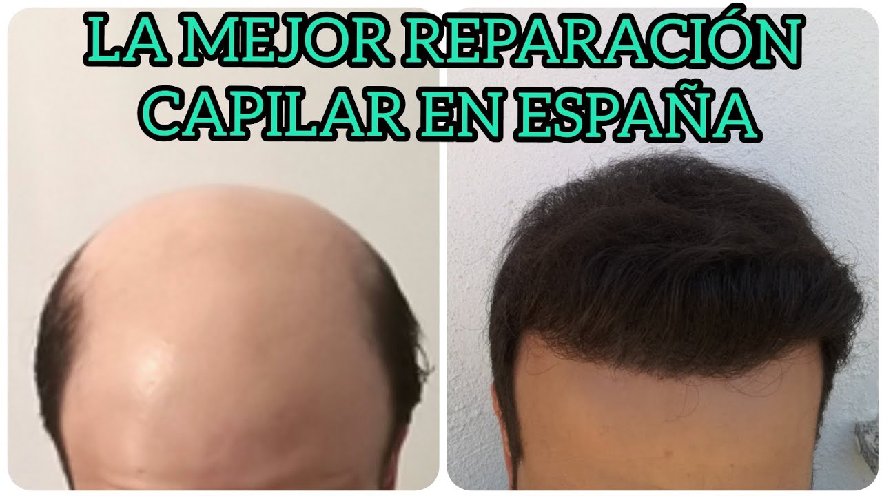 La MEJOR reparaci&oacute;n de INJERTO CAPILAR con la t&eacute;cnica FUE en Espa&ntilde;a 9100 UFs🤯