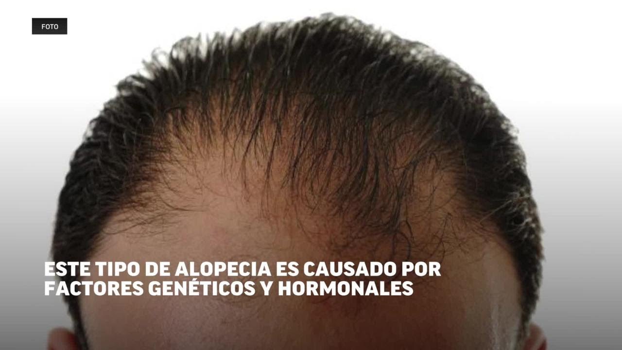 Calvicie en hombres