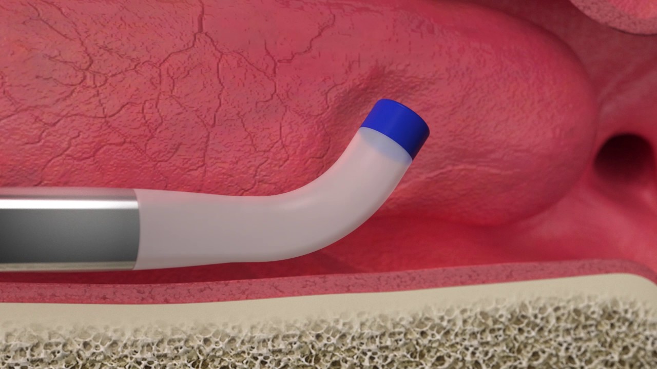Acclarent AERA Eustachian Tube Dilation System with Audio