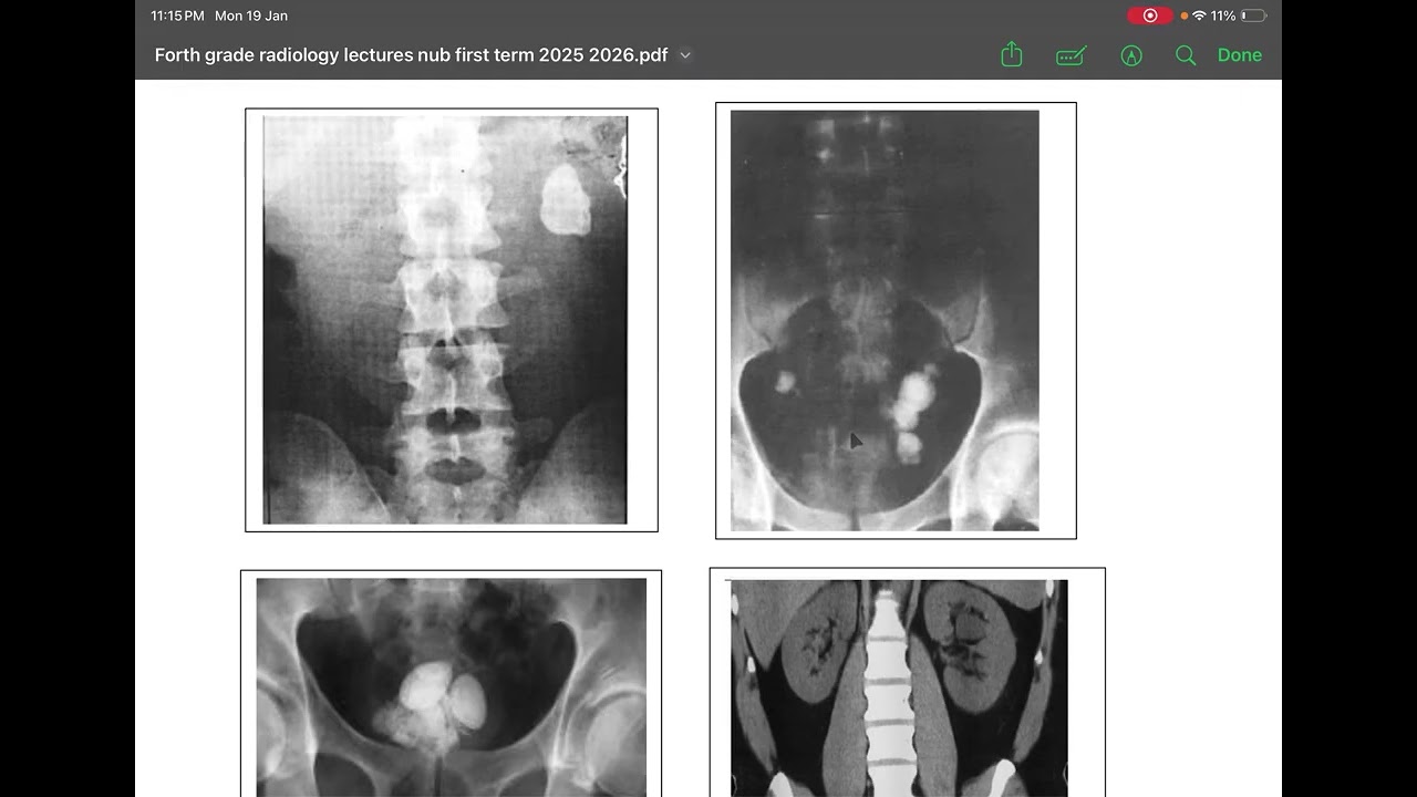 Radiology of urinary tract ( NUB )