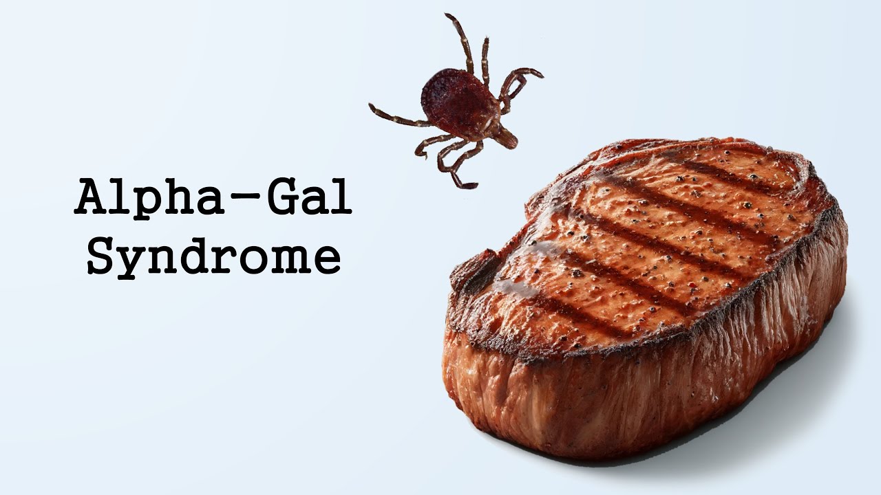 Alpha Gal Syndrome