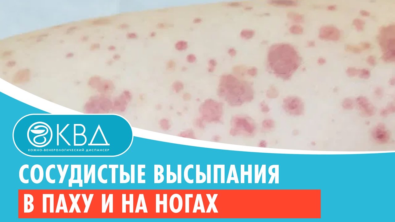 👉 Сосудистые высыпания в паху и на ногах. Клинический случай №821
