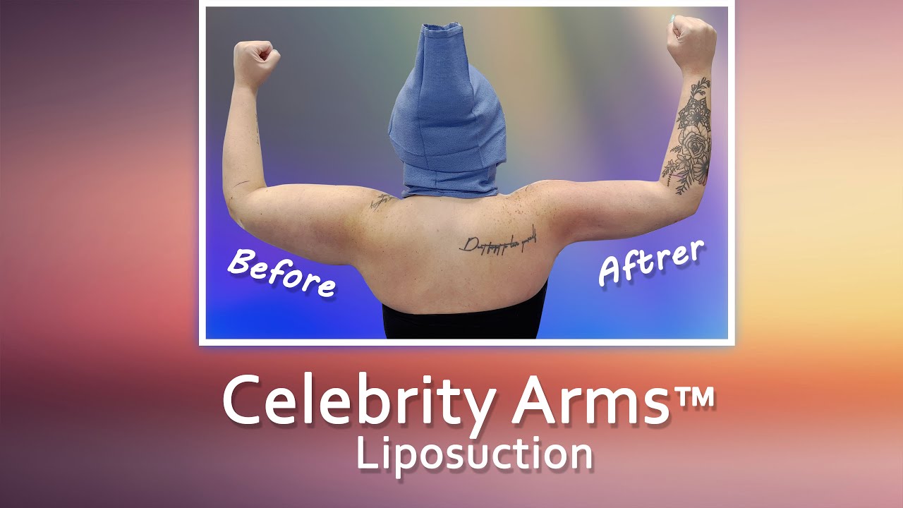 Arm Liposuction | Immediate Results | Celebrity Arms&trade; | Lipo 360&deg; |  Expert Dr. Thomas Su